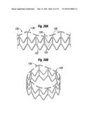 METHODS OF IMPLANTING A HEART VALVE AT AN AORTIC ANNULUS diagram and image