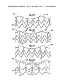 METHODS OF IMPLANTING A HEART VALVE AT AN AORTIC ANNULUS diagram and image