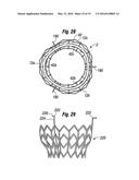 METHODS OF IMPLANTING A HEART VALVE AT AN AORTIC ANNULUS diagram and image