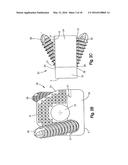 Intervertebral Implant with Fixation Geometry diagram and image