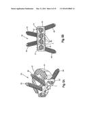 Intervertebral Implant with Fixation Geometry diagram and image