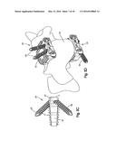 Intervertebral Implant with Fixation Geometry diagram and image