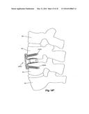 Intervertebral Implant with Fixation Geometry diagram and image