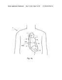 HEART HELP PUMP, SYSTEM, AND METHOD diagram and image