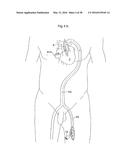 HEART HELP PUMP, SYSTEM, AND METHOD diagram and image