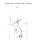 HEART HELP PUMP, SYSTEM, AND METHOD diagram and image