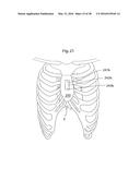 HEART HELP PUMP, SYSTEM, AND METHOD diagram and image