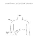 HEART HELP PUMP, SYSTEM, AND METHOD diagram and image