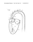 INTRACARDIAC PUMPING DEVICE diagram and image
