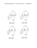 PRINTED ELECTRODE CATHETER diagram and image