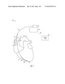 METHODS FOR DETECTING ATRIAL TACHYARRHYTHMIA IN IMPLANTABLE DEVICES     WITHOUT DEDICATED ATRIAL SENSING diagram and image