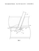 SYSTEMS, METHODS, AND DEVICES FOR CLOSING HOLES IN BODY LUMENS diagram and image