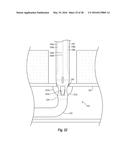 SYSTEMS, METHODS, AND DEVICES FOR CLOSING HOLES IN BODY LUMENS diagram and image