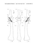 SOFT TISSUE RECONSTRUCTION diagram and image