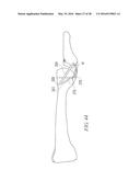 SOFT TISSUE RECONSTRUCTION diagram and image