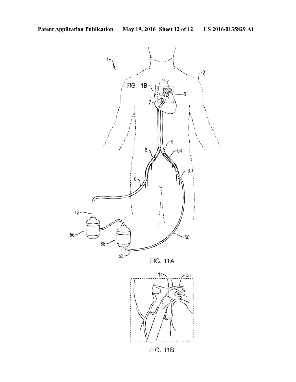 SYSTEMS AND METHODS FOR EN BLOC REMOVAL OF UNDESIRABLE MATERIAL FROM     PASSAGEWAYS - diagram, schematic, and image 13