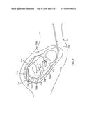 INTRAUTERINE BALLOON APPARATUS, SYSTEM, AND METHOD FOR AUGMENTING UTERINE     BIRTHING FORCES DURING PARTURITION diagram and image