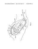 INTRAUTERINE BALLOON APPARATUS, SYSTEM, AND METHOD FOR AUGMENTING UTERINE     BIRTHING FORCES DURING PARTURITION diagram and image