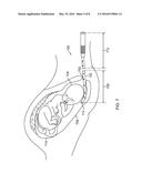 INTRAUTERINE ACCESS CATHETER FOR DELIVERING AND FACILITATING OPERATION OF     A MEDICAL APPARATUS FOR ASSISTING PARTURITION diagram and image