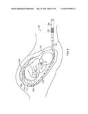 INTRAUTERINE ACCESS CATHETER FOR DELIVERING AND FACILITATING OPERATION OF     A MEDICAL APPARATUS FOR ASSISTING PARTURITION diagram and image