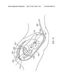 INTRAUTERINE ACCESS CATHETER FOR DELIVERING AND FACILITATING OPERATION OF     A MEDICAL APPARATUS FOR ASSISTING PARTURITION diagram and image