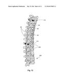 GROWING SPINAL RODS AND PEDICLE SCREWS FOR SECURING MULTIPLE SPINAL RODS diagram and image