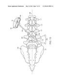 Facet screw and method for spinal stabilization diagram and image