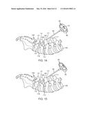 Facet screw and method for spinal stabilization diagram and image