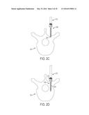 BONE ANCHORS AND SURGICAL INSTRUMENTS WITH INTEGRATED GUIDE TIPS diagram and image