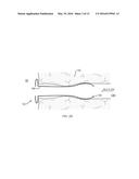 BILIARY STENTS AND METHODS diagram and image