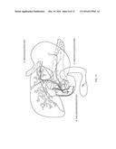 BILIARY STENTS AND METHODS diagram and image