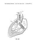 LOW PROFILE HEART VALVE AND DELIVERY SYSTEM diagram and image