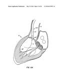 LOW PROFILE HEART VALVE AND DELIVERY SYSTEM diagram and image