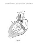 LOW PROFILE HEART VALVE AND DELIVERY SYSTEM diagram and image