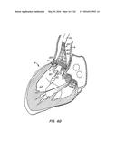 LOW PROFILE HEART VALVE AND DELIVERY SYSTEM diagram and image