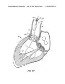 LOW PROFILE HEART VALVE AND DELIVERY SYSTEM diagram and image