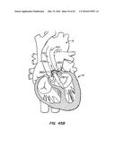 LOW PROFILE HEART VALVE AND DELIVERY SYSTEM diagram and image