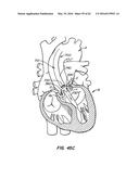 LOW PROFILE HEART VALVE AND DELIVERY SYSTEM diagram and image