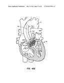 LOW PROFILE HEART VALVE AND DELIVERY SYSTEM diagram and image