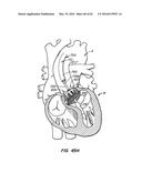 LOW PROFILE HEART VALVE AND DELIVERY SYSTEM diagram and image