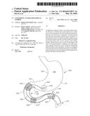 CONFORMING ANCHOR FOR DUODENAL BARRIER diagram and image