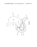 CONFORMING ANCHOR FOR DUODENAL BARRIER diagram and image