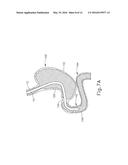 CONFORMING ANCHOR FOR DUODENAL BARRIER diagram and image