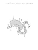 CONFORMING ANCHOR FOR DUODENAL BARRIER diagram and image