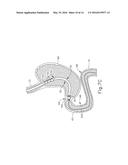 CONFORMING ANCHOR FOR DUODENAL BARRIER diagram and image