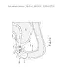 CONFORMING ANCHOR FOR DUODENAL BARRIER diagram and image