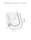 CONFORMING ANCHOR FOR DUODENAL BARRIER diagram and image