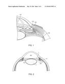 DELIVERY SYSTEM FOR OCULAR IMPLANT diagram and image