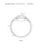 DELIVERY SYSTEM FOR OCULAR IMPLANT diagram and image