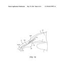 DELIVERY SYSTEM FOR OCULAR IMPLANT diagram and image